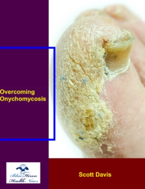 Overcoming Onychomycosis Reviews